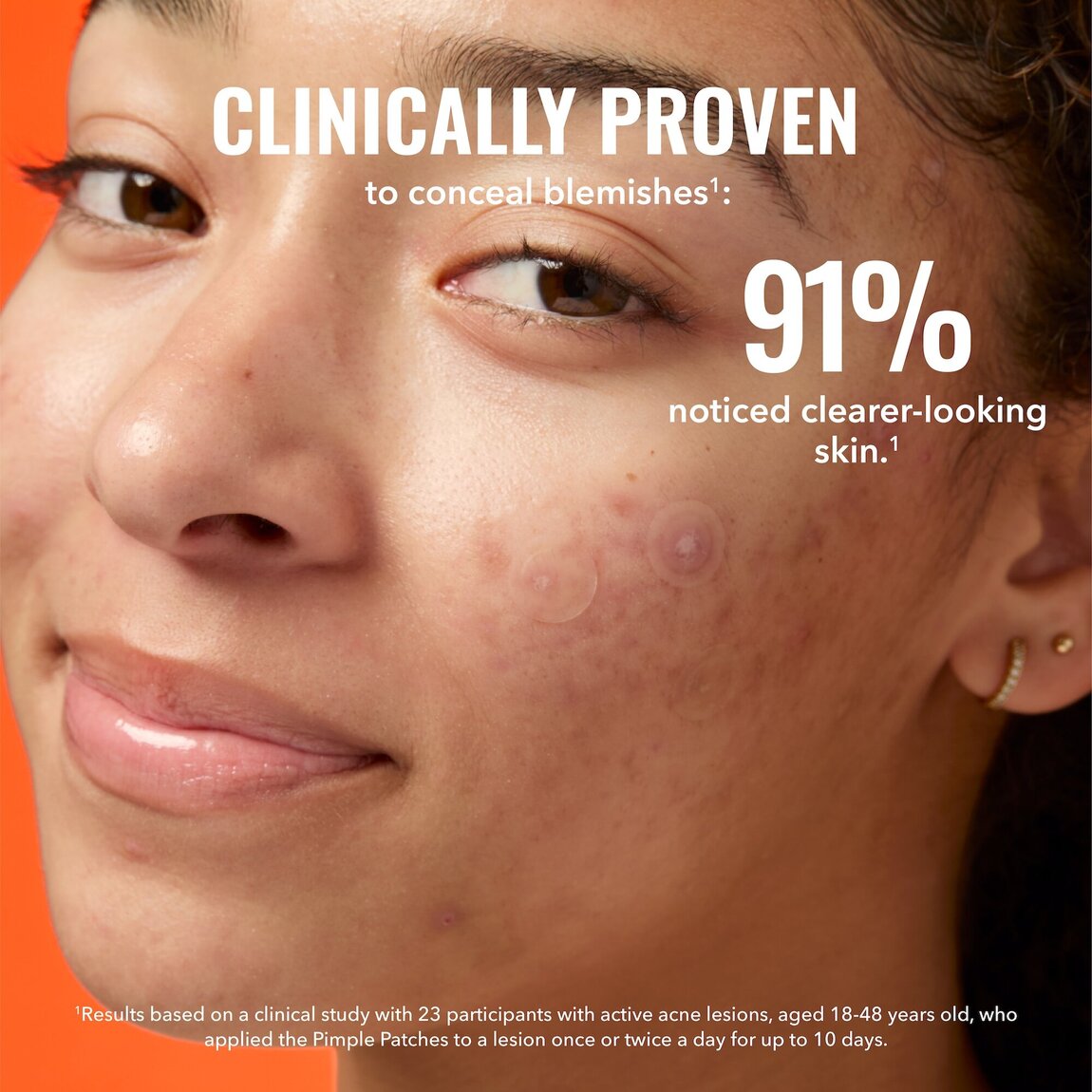 pimple-patches-v8 zb_p.jpg