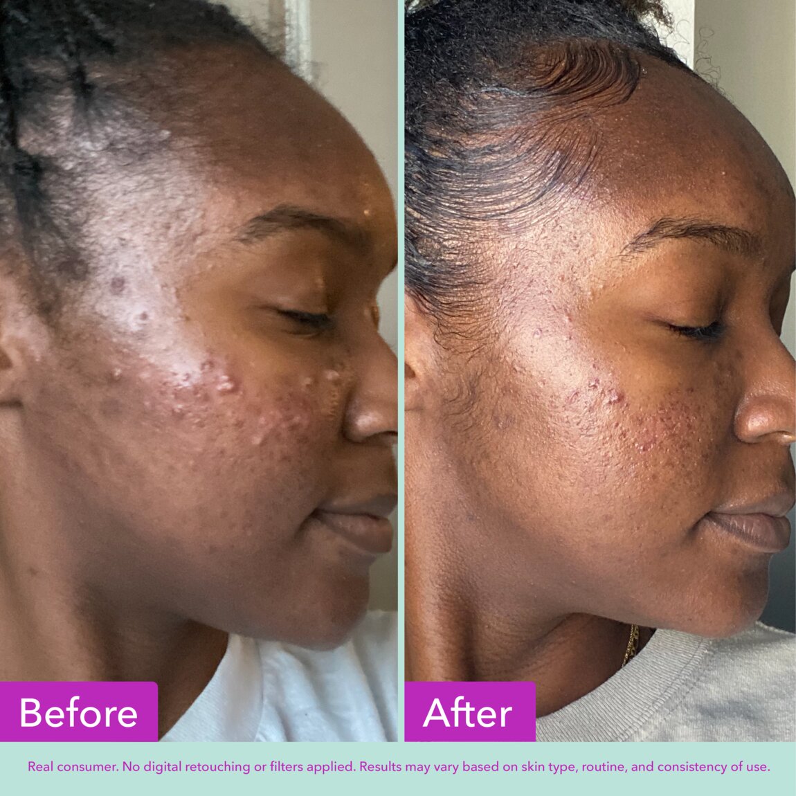 acne-foaming-cleanser-t9 zb_p.jpg
